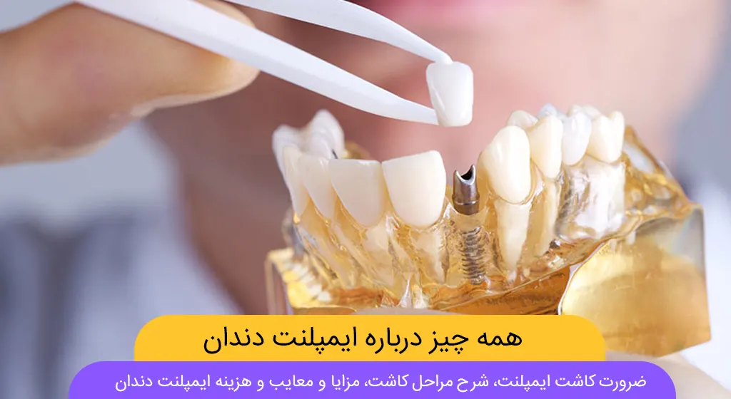 ایمپلنت دندان فک بالا و پایین در کلینیک دندانپزشکی مارکیز تهران، نمای نزدیک از دندان‌های کاشته شده