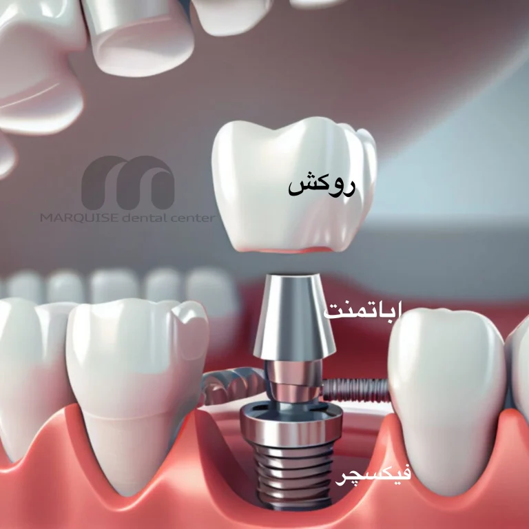 کلینیک تخصصی ایمپلنت دندان در پونک تهران با خدمات سینوس لیفت و پودر استخوان
