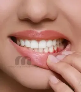 قبل و بعد درمان عفونت دندان در کلینیک دندانپزشکی مارکیز تهران