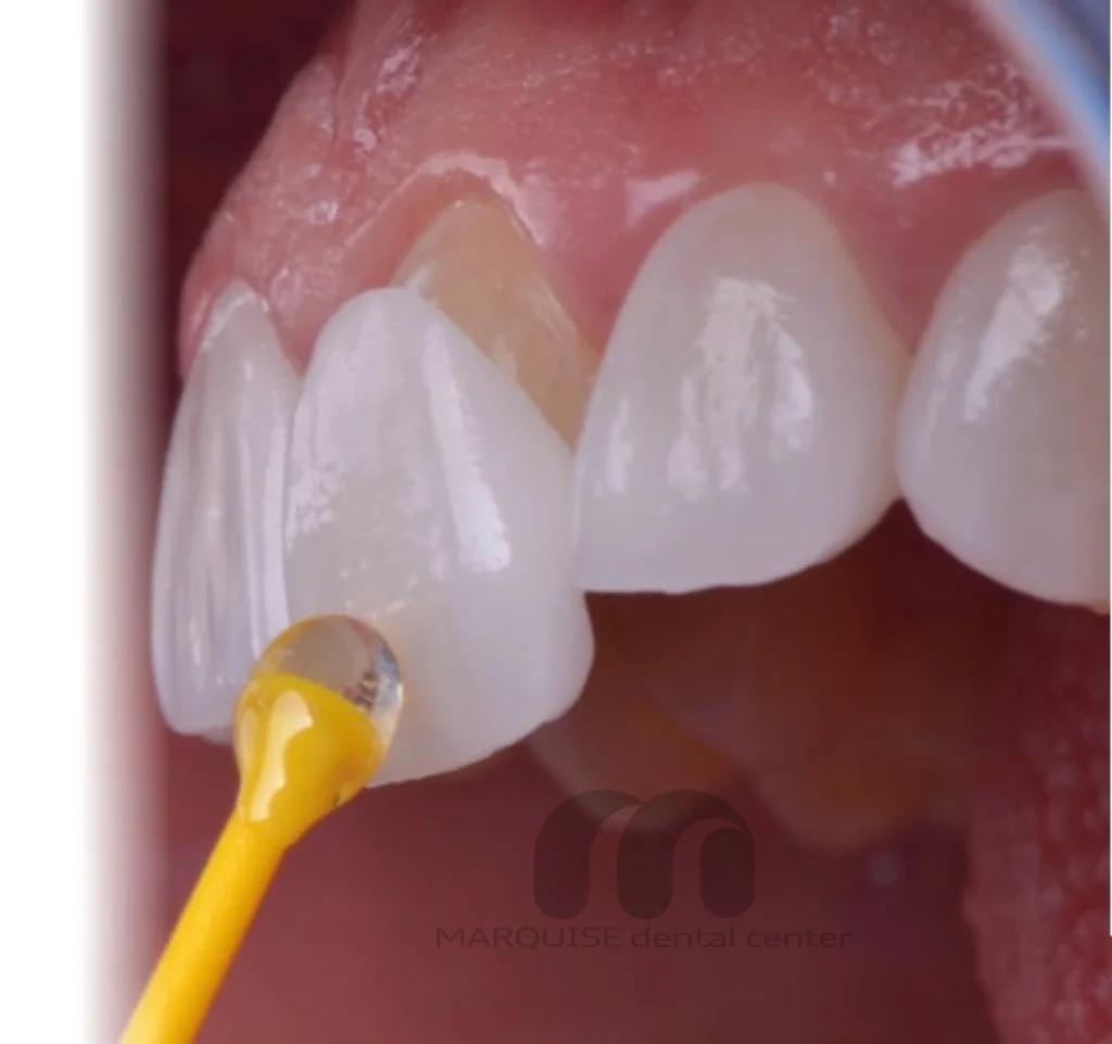 چسباندن لمینت IPS E.max با دقت بالا در کلینیک دندانپزشکی مارکیز