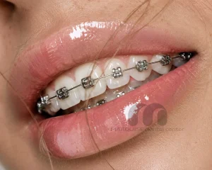 لبخند بیمار پس از نصب ارتودنسی ثابت در کلینیک مارکیز