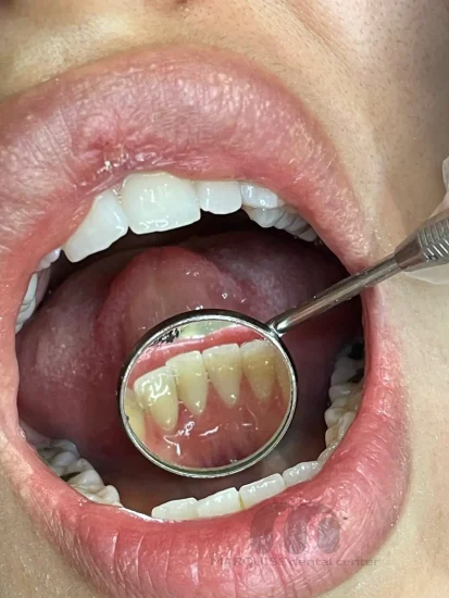 پولیش و صاف کردن سطح دندان بعد از جرم‌گیری در کلینیک دندانپزشکی مارکیز