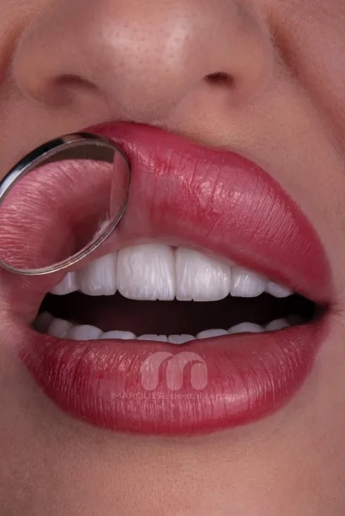 طراحی لبخند با لمینت سرامیکی در کلینیک دندانپزشکی مارکیز